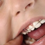 Скобы на зубах у ребенка