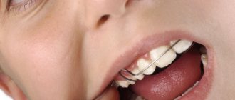 Скобы на зубах у ребенка