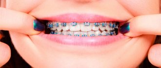 How long do you wear braces and what affects the timing?