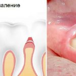 How long does it take for gums to heal after wisdom tooth removal?