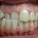 смещение зуба относительно всего ряда