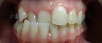 смещение зуба относительно всего ряда