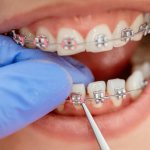 Removing braces in dentistry