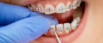 Removing braces in dentistry