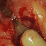 Preservation of teeth with root fractures