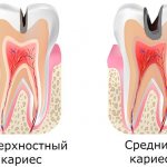 Stages of caries