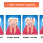 Stages of caries development in pictures