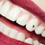 стразы на зубах у человека