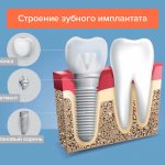 The structure of a dental implant in pictures