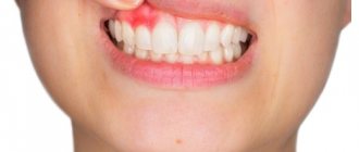 Fistula or lump on the gum - what to do?