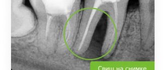 dental fistula on x-ray