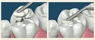 Свойства стеклоиономерного цемента для пломбирования зубов