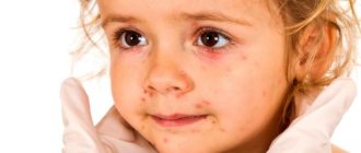 Rash around a child&#39;s mouth. Causes 2-3, 5-6 years, how to treat, what Komarovsky advises 