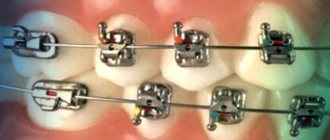 Treatment tactics with Empower braces