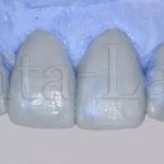 Wax-up and Mock-up technology in dentistry