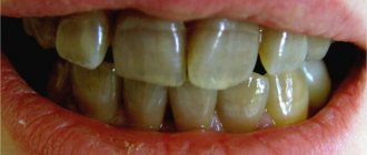 тетрациклиновые зубы