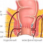 Types of rectal fistulas