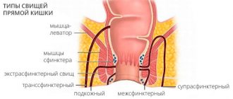 Types of rectal fistulas