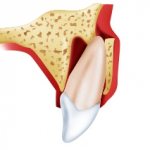 Tooth injury: dislocation