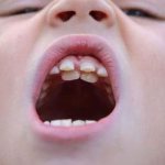 У детей акульи зубы что делать опасно или нет