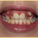 У ребенка режутся зубы и клыки