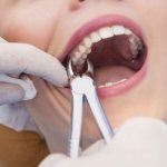 Removing the root of a rotten, decayed tooth