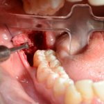 removal of a lying wisdom tooth