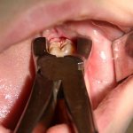удаление нижнего зуба