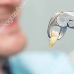 Удаление зубов с выступившим герпесом