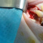 removal of premolars