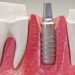 Installation of a dental implant