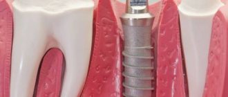 Установка имплантанта зуба
