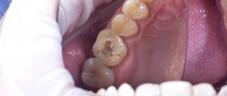 installing a filling on a tooth price