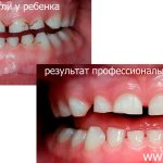 eliminating dark plaque on a child’s teeth