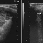 ultrasound of the salivary glands