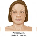 Варианты разреза при резекции нижней челюсти