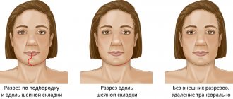 Варианты разреза при резекции нижней челюсти