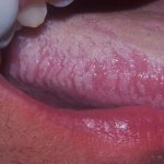 HIV oral infection