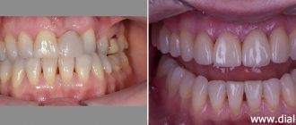 вид зубов до и после комплексного лечения с имплантацией и протезированием