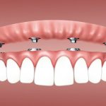types of removable dentures