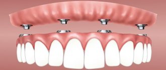 types of removable dentures