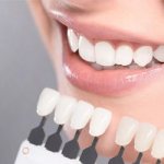 Types of veneers - Smile Line Dentistry