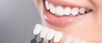 Types of veneers - Smile Line Dentistry