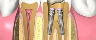 Types of dental pins