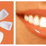 veneers pros and cons