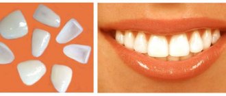 veneers pros and cons