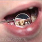 external discoloration of teeth
