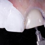 Intraoral air abrasive treatment: methods, devices, application possibilities