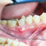 воспаление надкостницы зуба