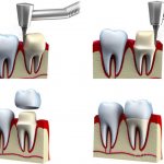 Восстановление коронки зуба